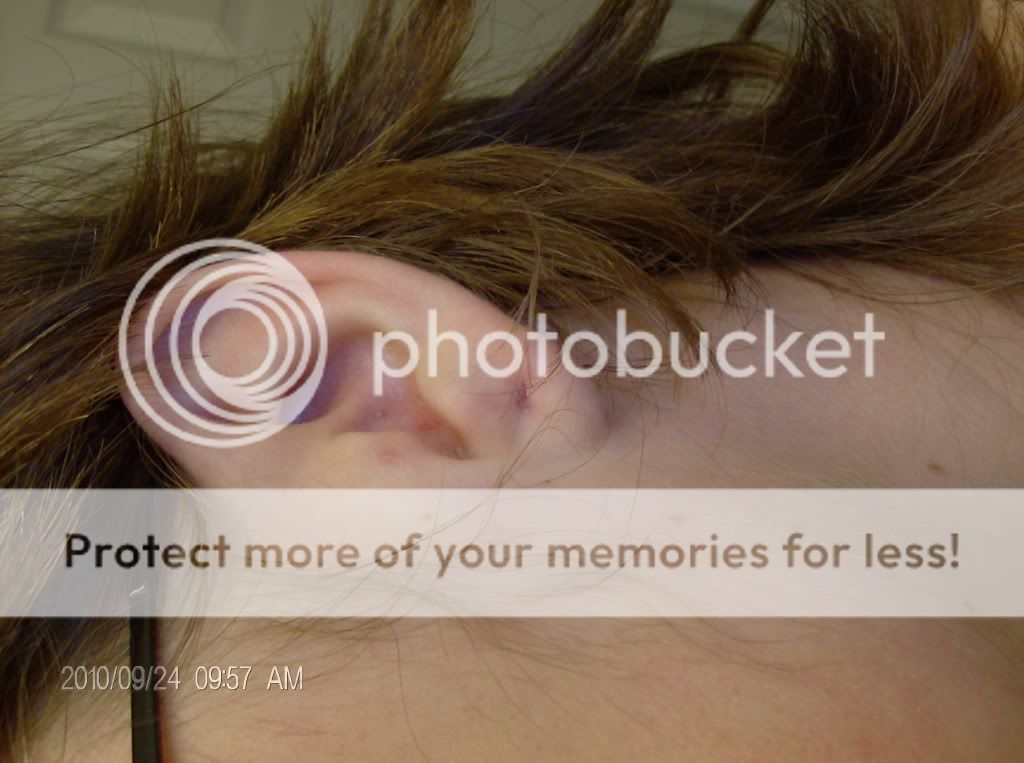 2 Gauge Tunnel Ripped Out of Ear