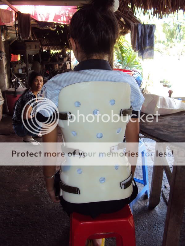 Quận 9 bé Huyền Trân bị vẹo cột sống bẩm sinh - 1